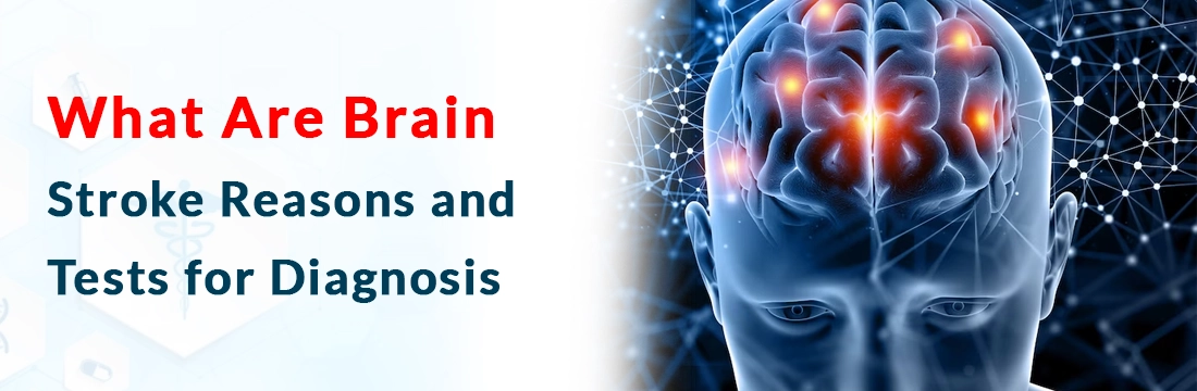  What Are Brain Stroke Reasons and Tests for Diagnosis